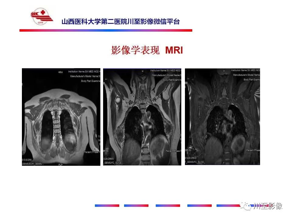 影像PPT - 【PPT】弹力纤维瘤-9
