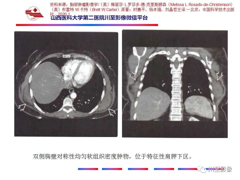 影像PPT - 【PPT】弹力纤维瘤-17