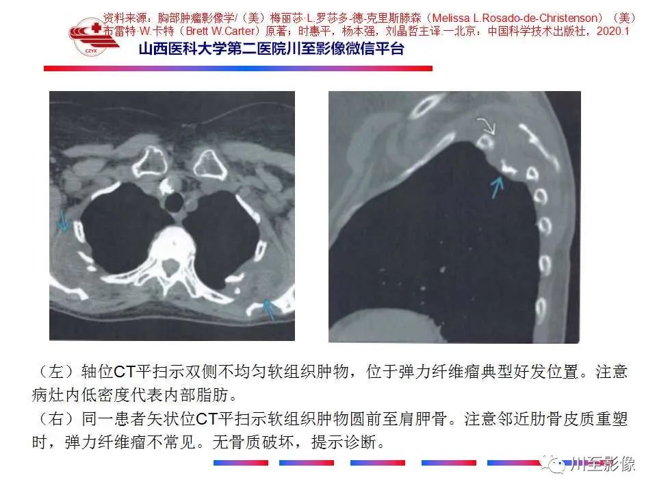 影像PPT - 【PPT】弹力纤维瘤-18