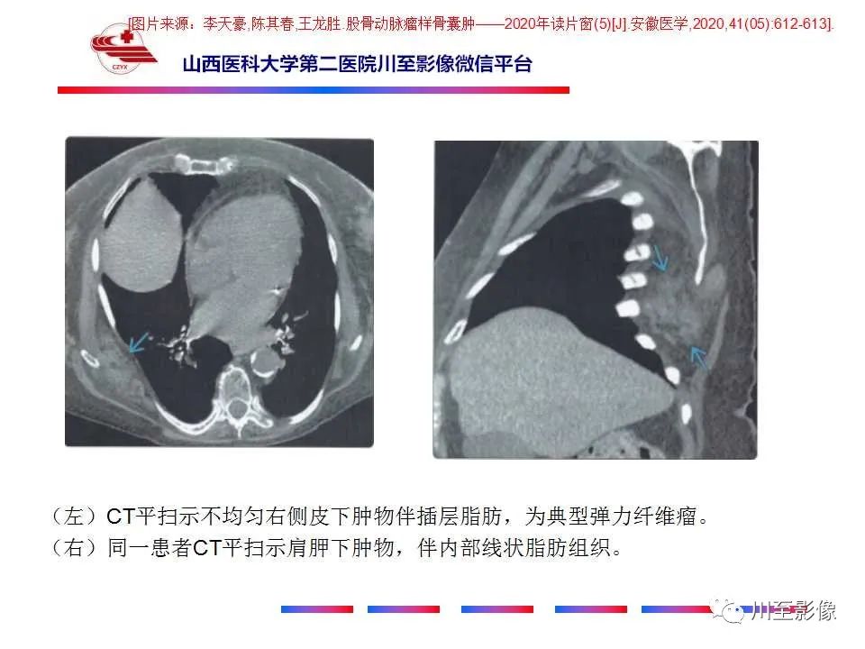 影像PPT - 【PPT】弹力纤维瘤-19