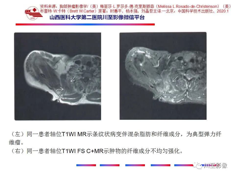影像PPT - 【PPT】弹力纤维瘤-22