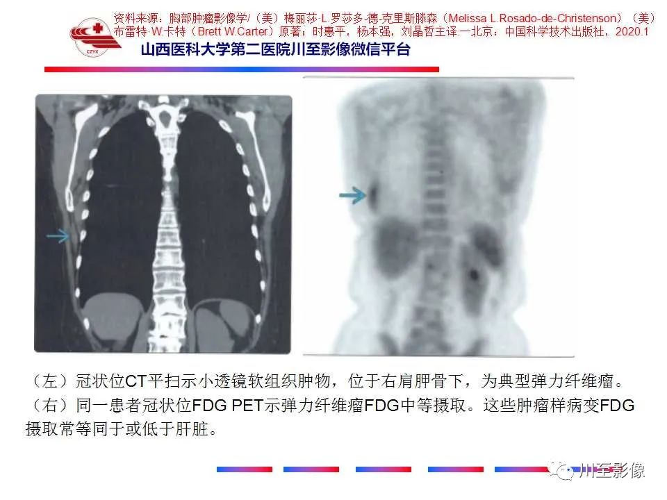 影像PPT - 【PPT】弹力纤维瘤-24