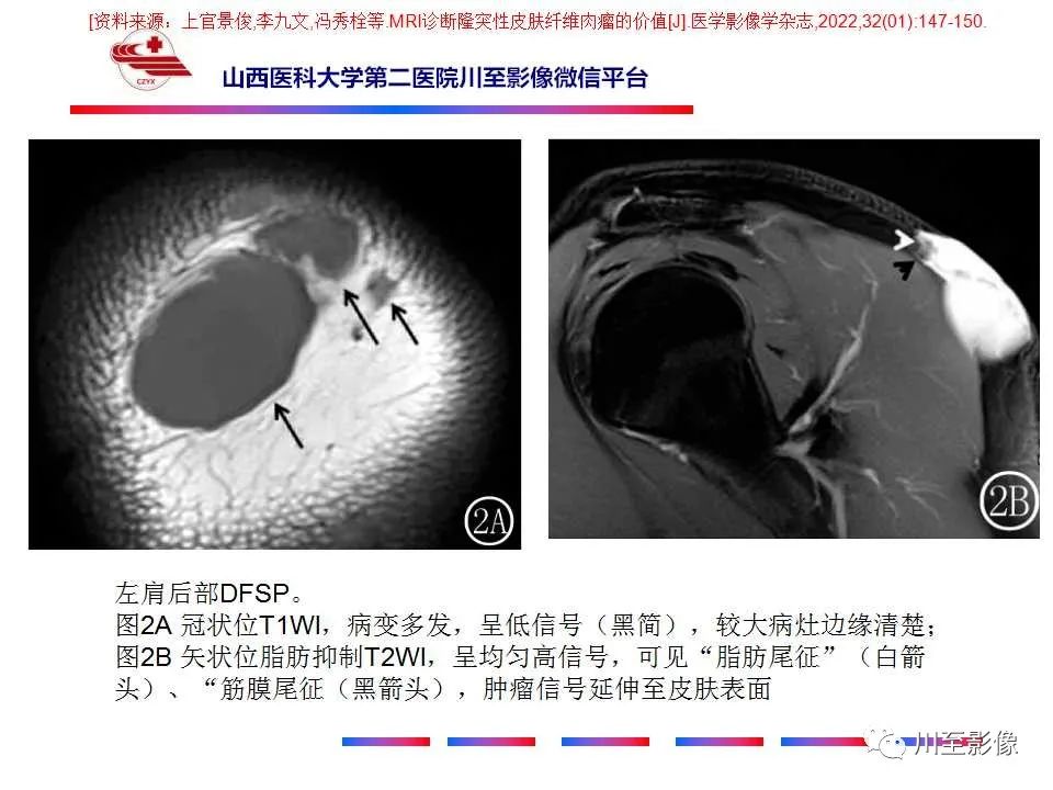 影像PPT - 【PPT】弹力纤维瘤-26