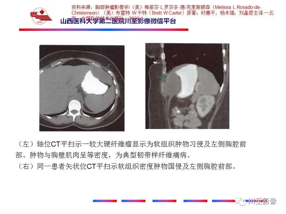 影像PPT - 【PPT】弹力纤维瘤-30