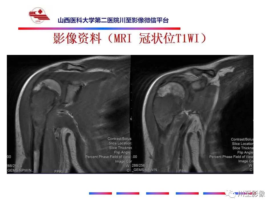 影像PPT - 【病例】肱骨动脉瘤样骨囊肿1例X线CT及MR影像-5 影像PPT - 【病例】肱骨动脉瘤样骨囊肿1例X线CT及MR影像-5