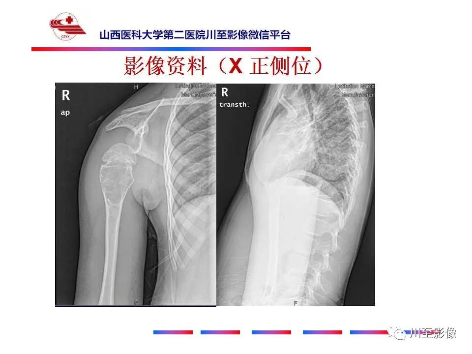 影像PPT - 【病例】肱骨动脉瘤样骨囊肿1例X线CT及MR影像-4 影像PPT - 【病例】肱骨动脉瘤样骨囊肿1例X线CT及MR影像-4