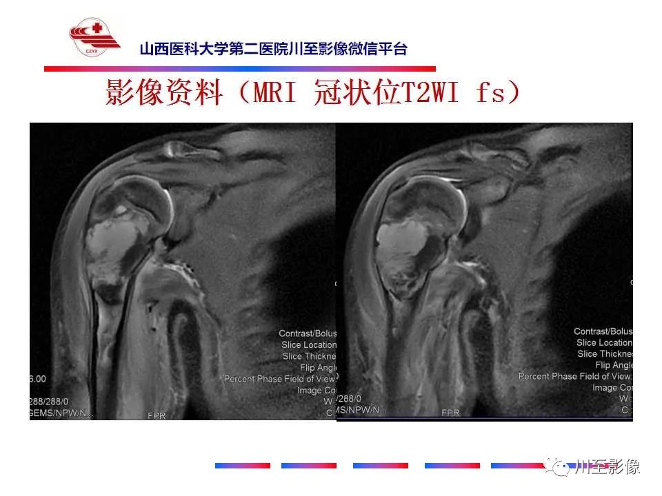 影像PPT - 【病例】肱骨动脉瘤样骨囊肿1例X线CT及MR影像-6 影像PPT - 【病例】肱骨动脉瘤样骨囊肿1例X线CT及MR影像-6