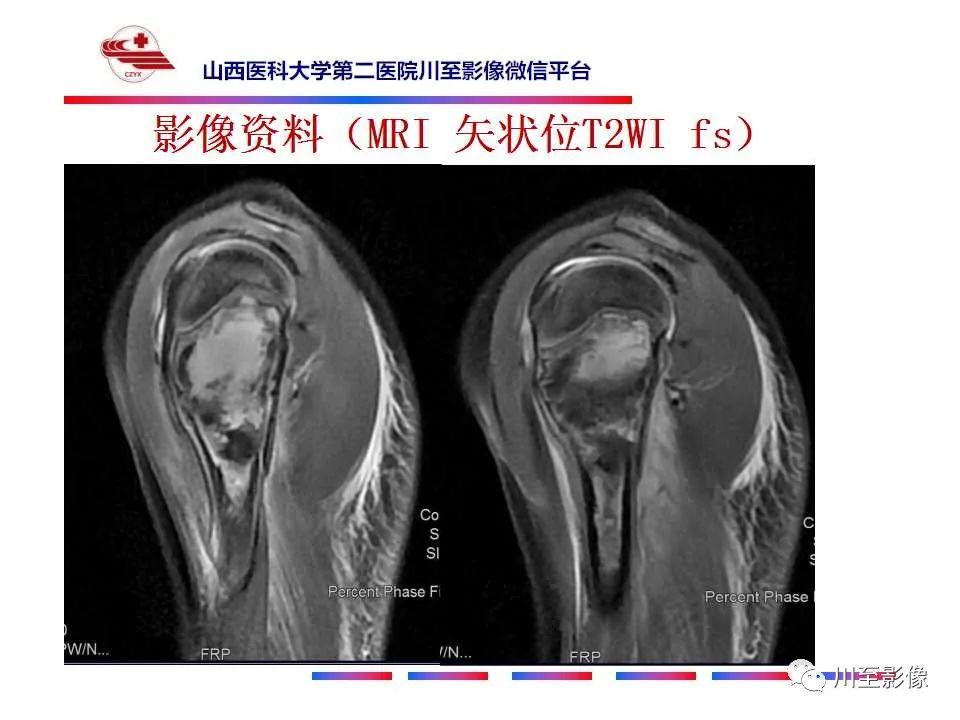 影像PPT - 【病例】肱骨动脉瘤样骨囊肿1例X线CT及MR影像-7 影像PPT - 【病例】肱骨动脉瘤样骨囊肿1例X线CT及MR影像-7