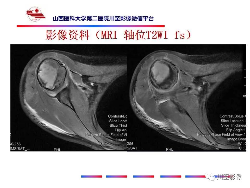 影像PPT - 【病例】肱骨动脉瘤样骨囊肿1例X线CT及MR影像-8 影像PPT - 【病例】肱骨动脉瘤样骨囊肿1例X线CT及MR影像-8