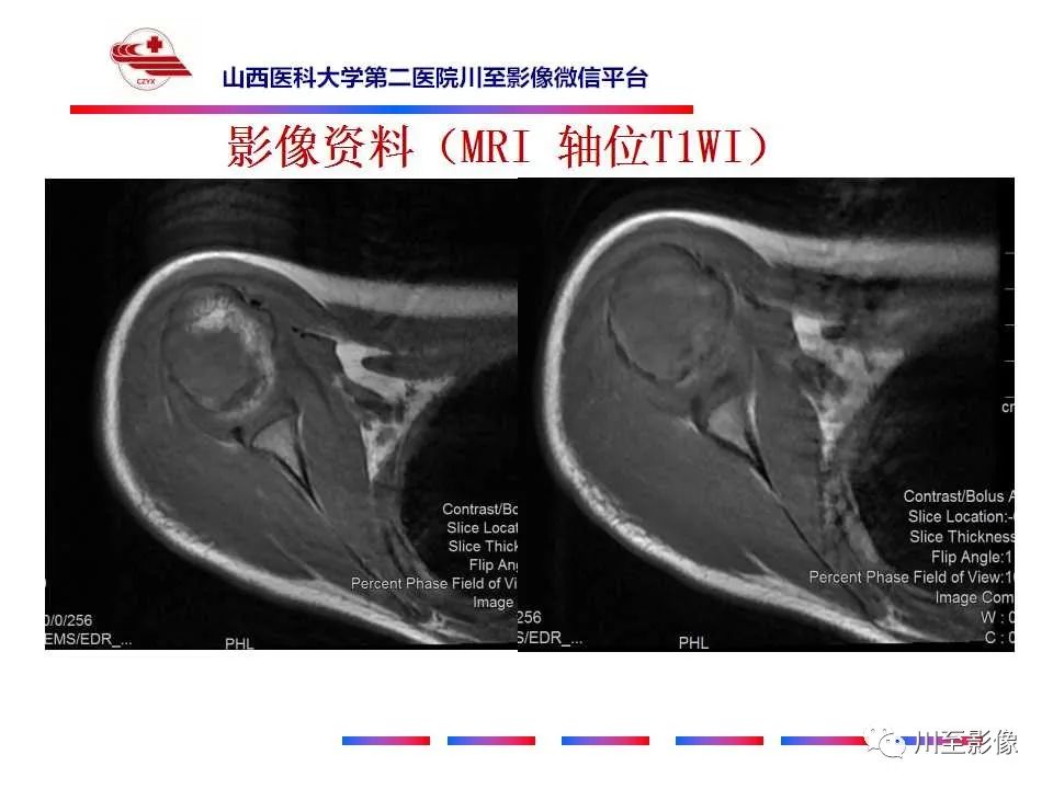 影像PPT - 【病例】肱骨动脉瘤样骨囊肿1例X线CT及MR影像-9 影像PPT - 【病例】肱骨动脉瘤样骨囊肿1例X线CT及MR影像-9