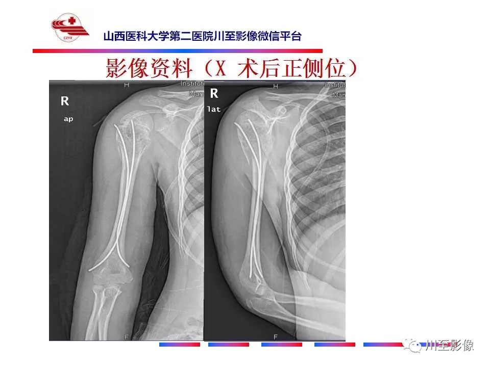 影像PPT - 【病例】肱骨动脉瘤样骨囊肿1例X线CT及MR影像-10 影像PPT - 【病例】肱骨动脉瘤样骨囊肿1例X线CT及MR影像-10