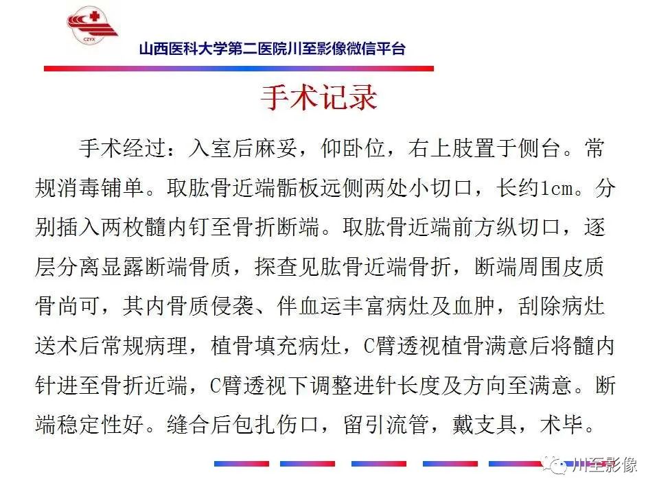 影像PPT - 【病例】肱骨动脉瘤样骨囊肿1例X线CT及MR影像-11 影像PPT - 【病例】肱骨动脉瘤样骨囊肿1例X线CT及MR影像-11