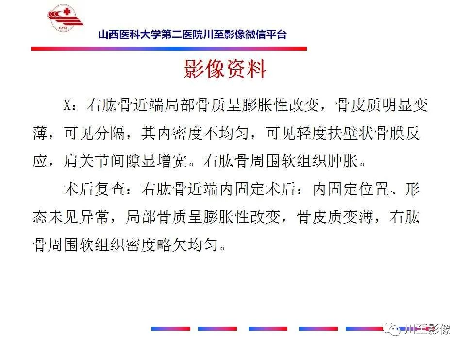 影像PPT - 【病例】肱骨动脉瘤样骨囊肿1例X线CT及MR影像-12 影像PPT - 【病例】肱骨动脉瘤样骨囊肿1例X线CT及MR影像-12