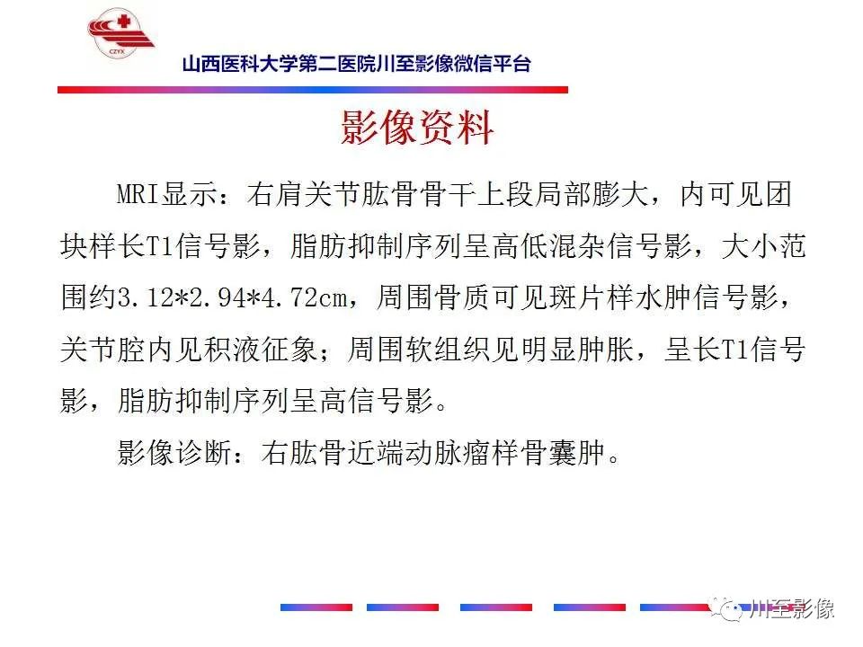 影像PPT - 【病例】肱骨动脉瘤样骨囊肿1例X线CT及MR影像-13 影像PPT - 【病例】肱骨动脉瘤样骨囊肿1例X线CT及MR影像-13
