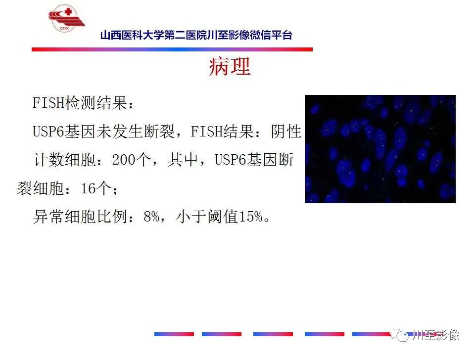 影像PPT - 【病例】肱骨动脉瘤样骨囊肿1例X线CT及MR影像-15 影像PPT - 【病例】肱骨动脉瘤样骨囊肿1例X线CT及MR影像-15