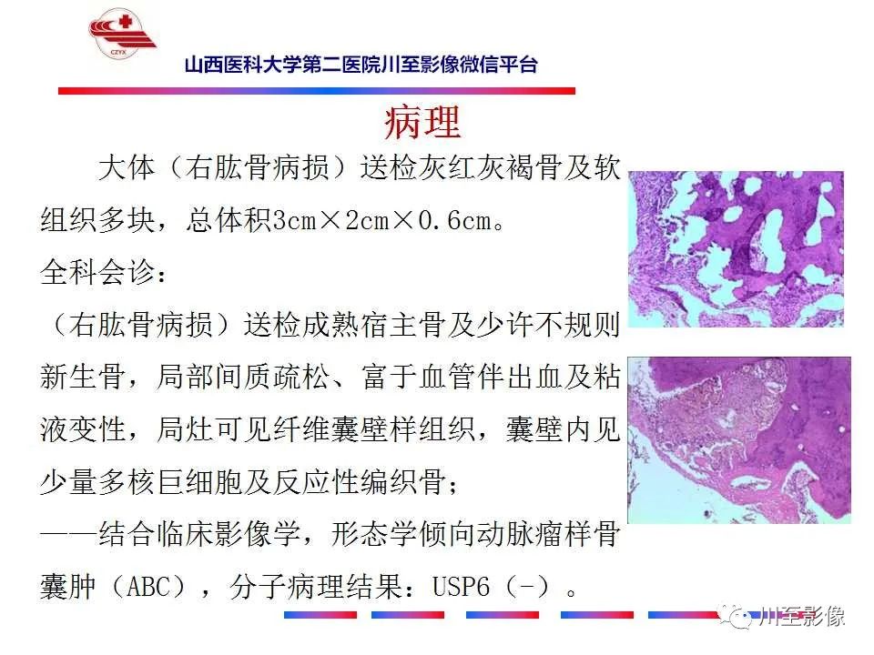 影像PPT - 【病例】肱骨动脉瘤样骨囊肿1例X线CT及MR影像-14 影像PPT - 【病例】肱骨动脉瘤样骨囊肿1例X线CT及MR影像-14