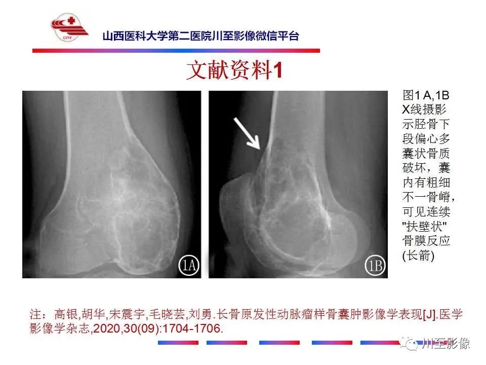影像PPT - 【病例】肱骨动脉瘤样骨囊肿1例X线CT及MR影像-25 影像PPT - 【病例】肱骨动脉瘤样骨囊肿1例X线CT及MR影像-25