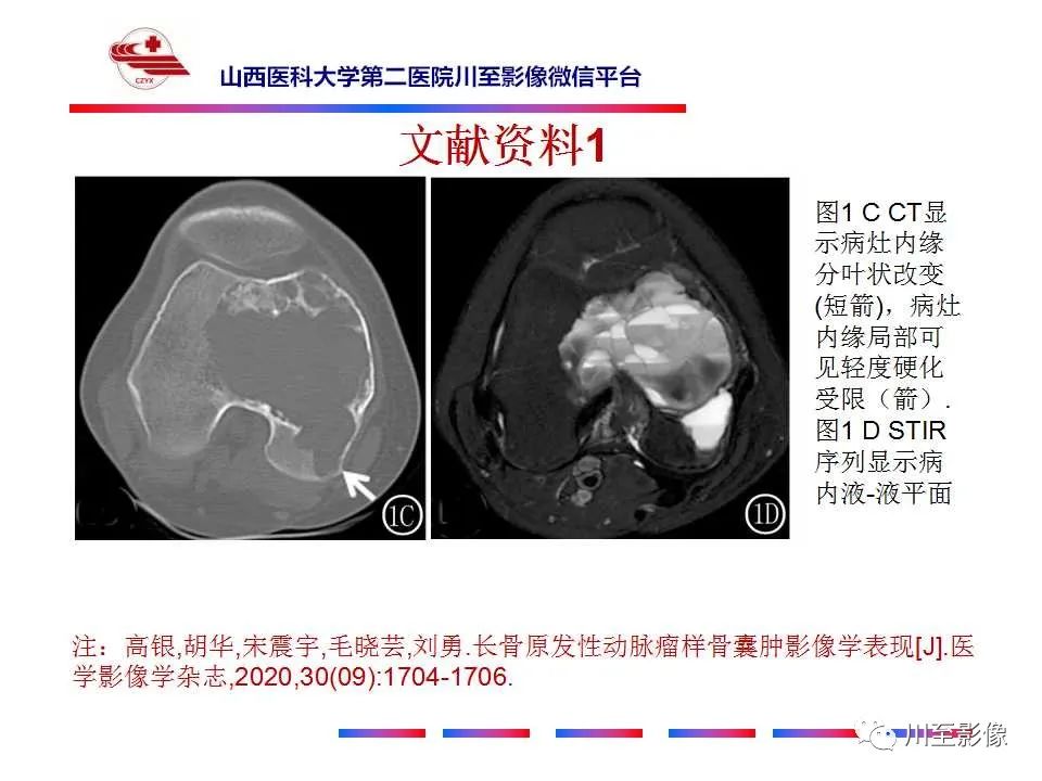 影像PPT - 【病例】肱骨动脉瘤样骨囊肿1例X线CT及MR影像-26 影像PPT - 【病例】肱骨动脉瘤样骨囊肿1例X线CT及MR影像-26