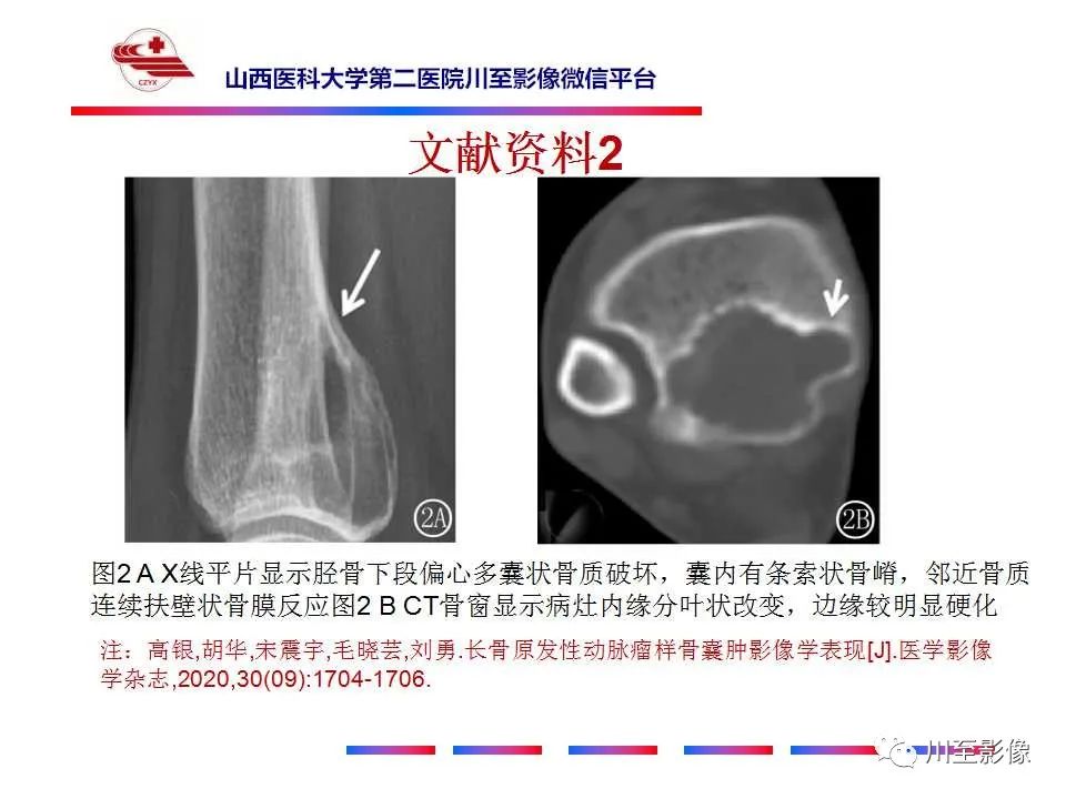 影像PPT - 【病例】肱骨动脉瘤样骨囊肿1例X线CT及MR影像-27 影像PPT - 【病例】肱骨动脉瘤样骨囊肿1例X线CT及MR影像-27