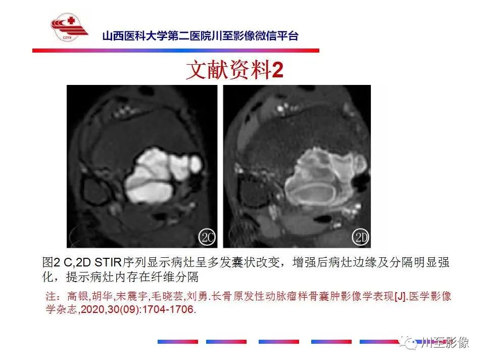 影像PPT - 【病例】肱骨动脉瘤样骨囊肿1例X线CT及MR影像-28 影像PPT - 【病例】肱骨动脉瘤样骨囊肿1例X线CT及MR影像-28
