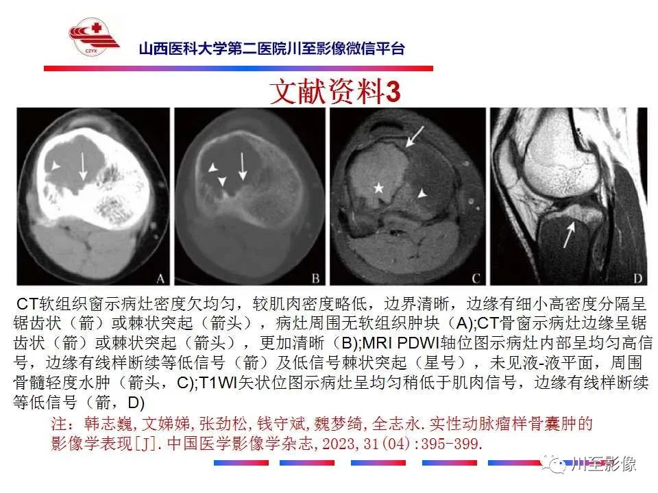 影像PPT - 【病例】肱骨动脉瘤样骨囊肿1例X线CT及MR影像-37 影像PPT - 【病例】肱骨动脉瘤样骨囊肿1例X线CT及MR影像-37