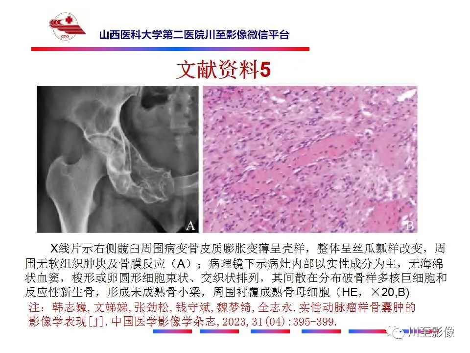影像PPT - 【病例】肱骨动脉瘤样骨囊肿1例X线CT及MR影像-39 影像PPT - 【病例】肱骨动脉瘤样骨囊肿1例X线CT及MR影像-39