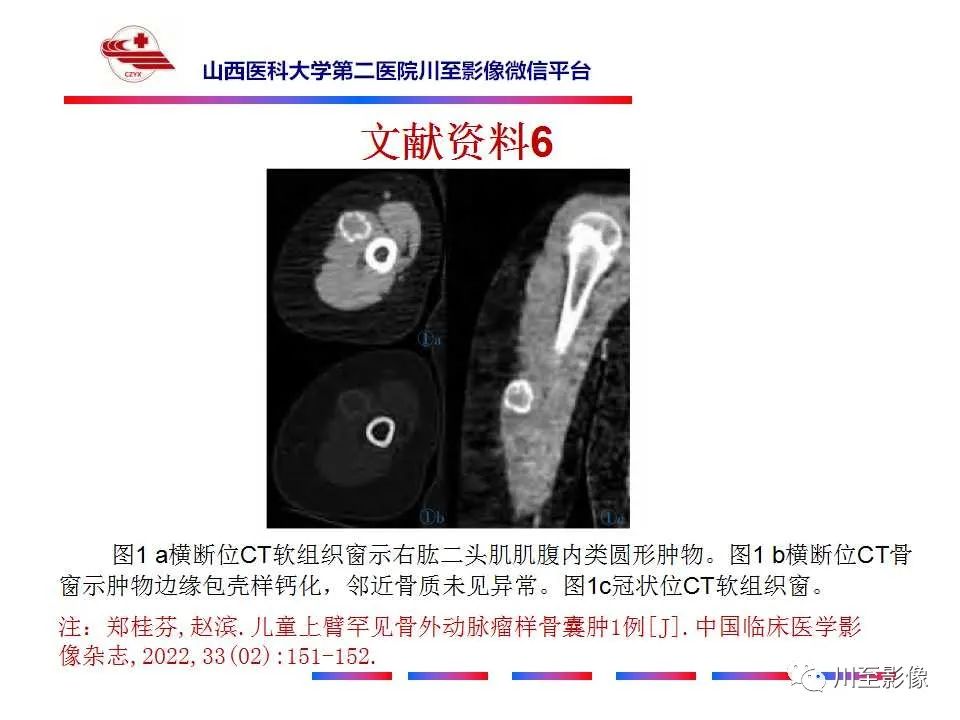 影像PPT - 【病例】肱骨动脉瘤样骨囊肿1例X线CT及MR影像-48 影像PPT - 【病例】肱骨动脉瘤样骨囊肿1例X线CT及MR影像-48