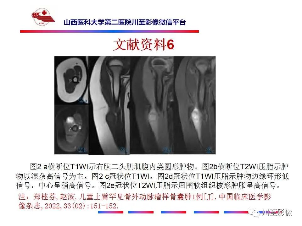 影像PPT - 【病例】肱骨动脉瘤样骨囊肿1例X线CT及MR影像-49 影像PPT - 【病例】肱骨动脉瘤样骨囊肿1例X线CT及MR影像-49