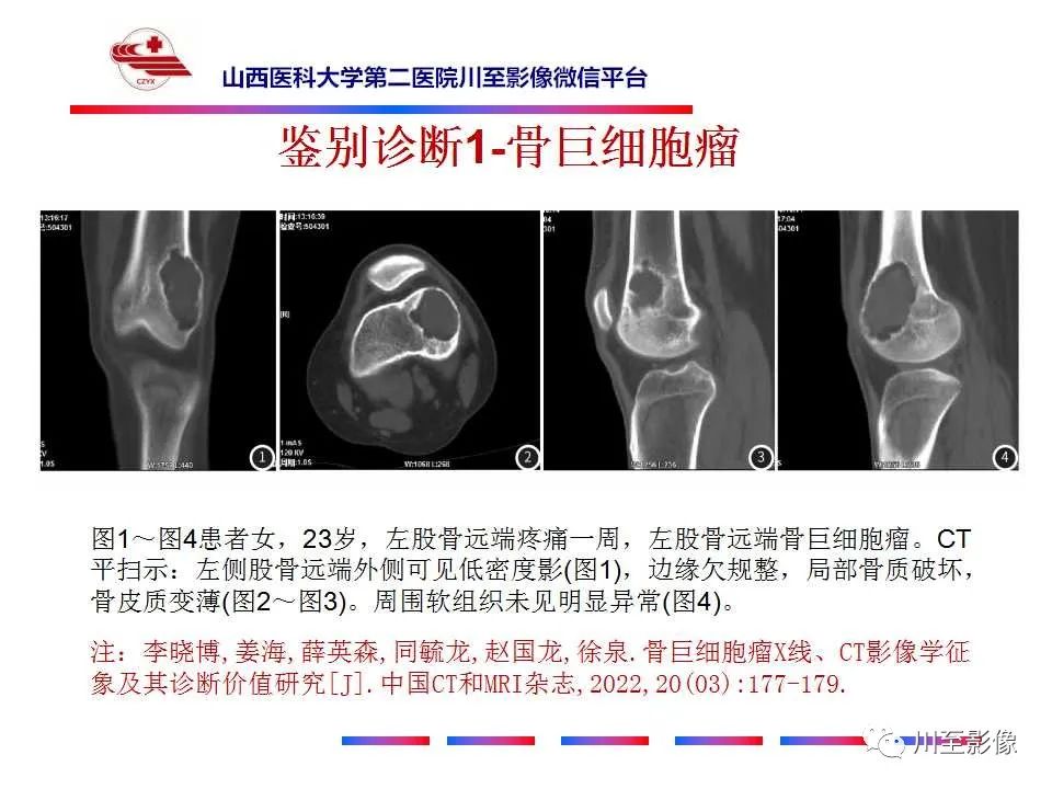 影像PPT - 【病例】肱骨动脉瘤样骨囊肿1例X线CT及MR影像-51 影像PPT - 【病例】肱骨动脉瘤样骨囊肿1例X线CT及MR影像-51