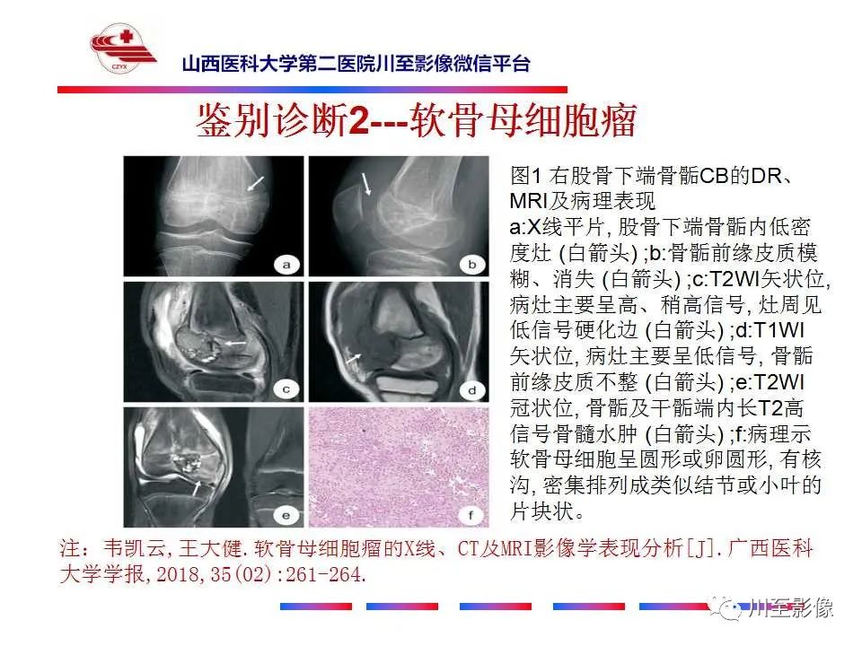 影像PPT - 【病例】肱骨动脉瘤样骨囊肿1例X线CT及MR影像-54 影像PPT - 【病例】肱骨动脉瘤样骨囊肿1例X线CT及MR影像-54