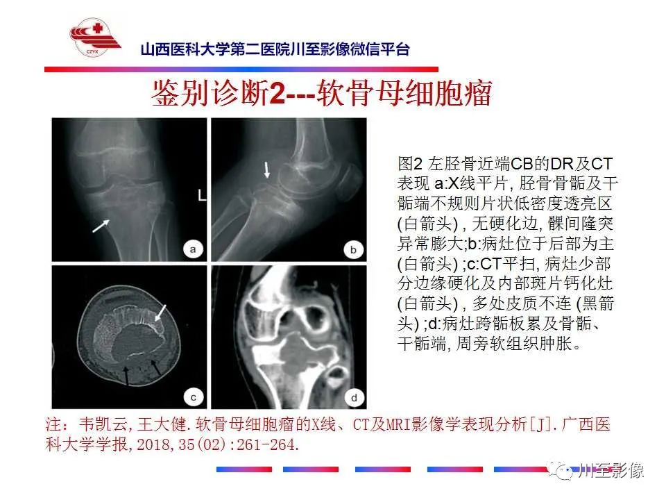 影像PPT - 【病例】肱骨动脉瘤样骨囊肿1例X线CT及MR影像-55 影像PPT - 【病例】肱骨动脉瘤样骨囊肿1例X线CT及MR影像-55