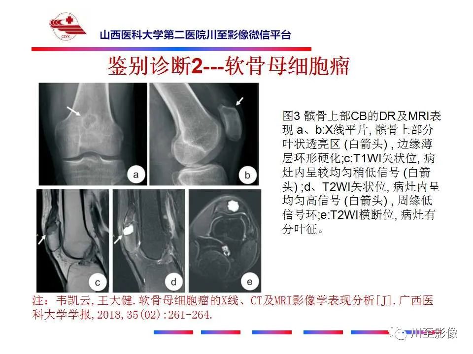 影像PPT - 【病例】肱骨动脉瘤样骨囊肿1例X线CT及MR影像-56 影像PPT - 【病例】肱骨动脉瘤样骨囊肿1例X线CT及MR影像-56