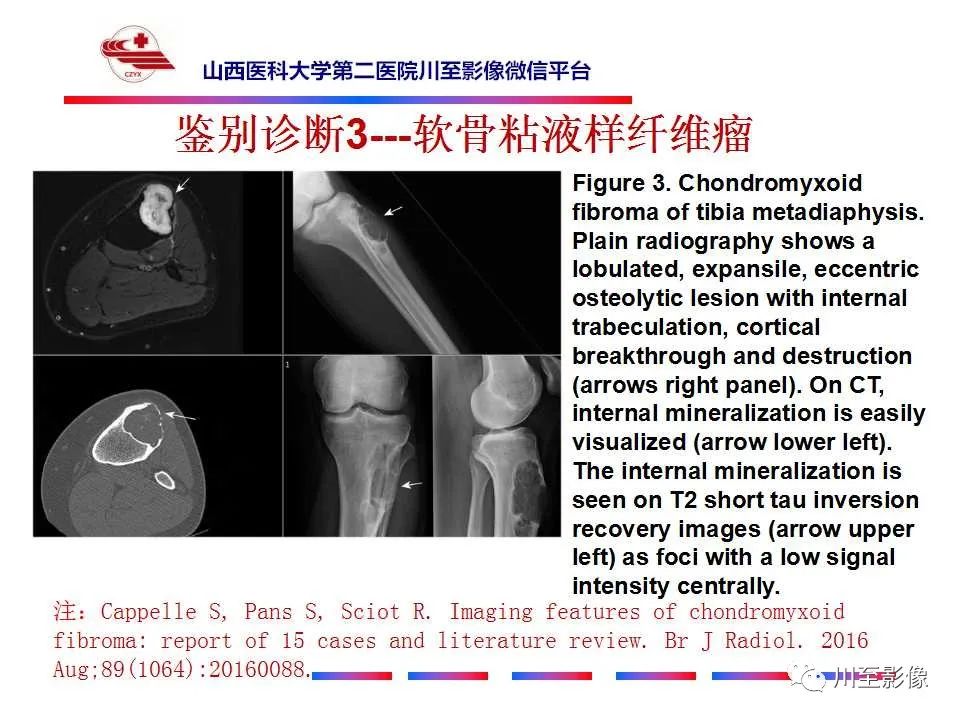 影像PPT - 【病例】肱骨动脉瘤样骨囊肿1例X线CT及MR影像-58 影像PPT - 【病例】肱骨动脉瘤样骨囊肿1例X线CT及MR影像-58