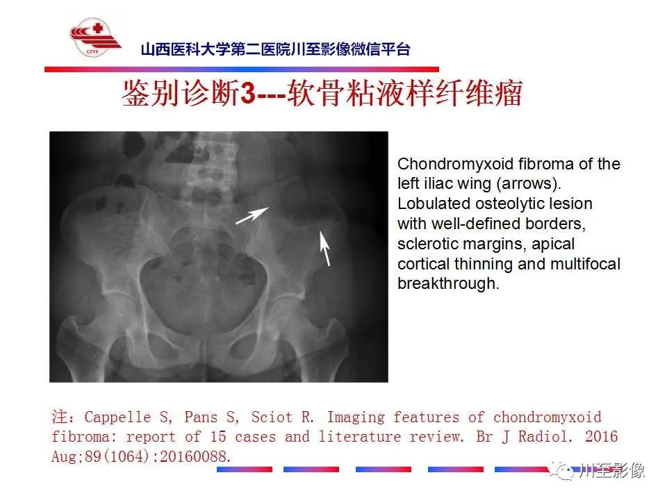 影像PPT - 【病例】肱骨动脉瘤样骨囊肿1例X线CT及MR影像-59 影像PPT - 【病例】肱骨动脉瘤样骨囊肿1例X线CT及MR影像-59