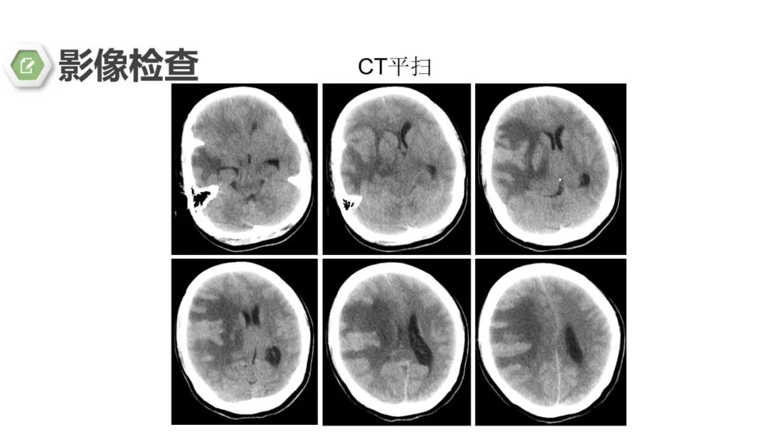 影像PPT - 【病例】颅内结核1例CT及MR影像-8 影像PPT - 【病例】颅内结核1例CT及MR影像-8