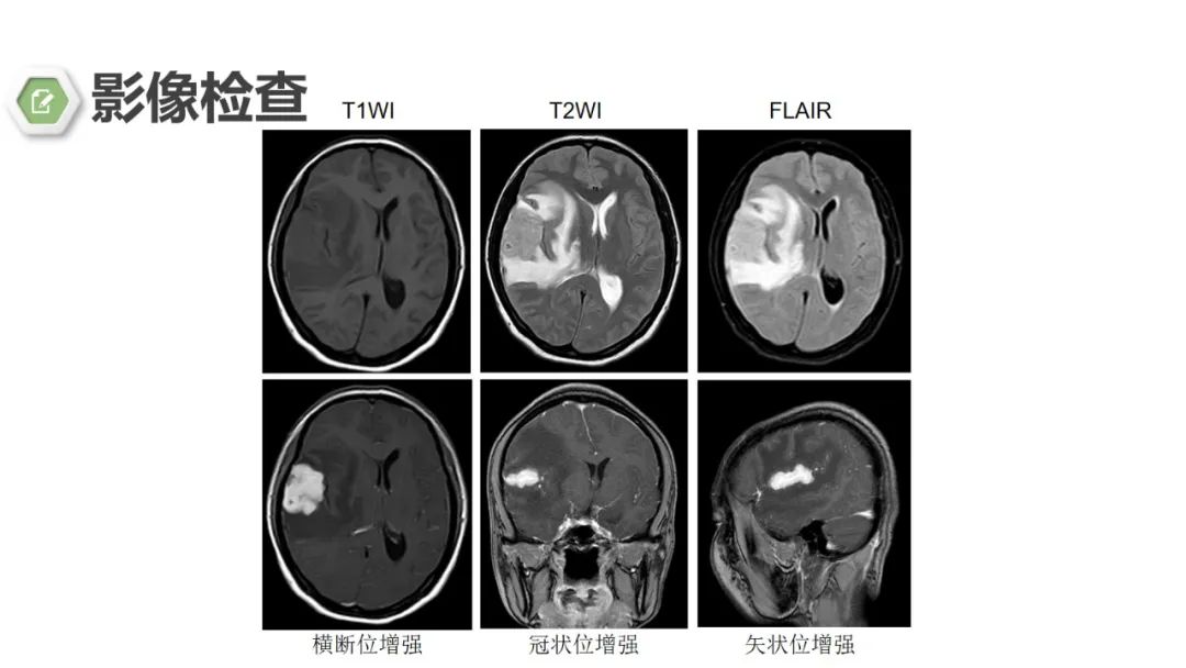 影像PPT - 【病例】颅内结核1例CT及MR影像-10 影像PPT - 【病例】颅内结核1例CT及MR影像-10