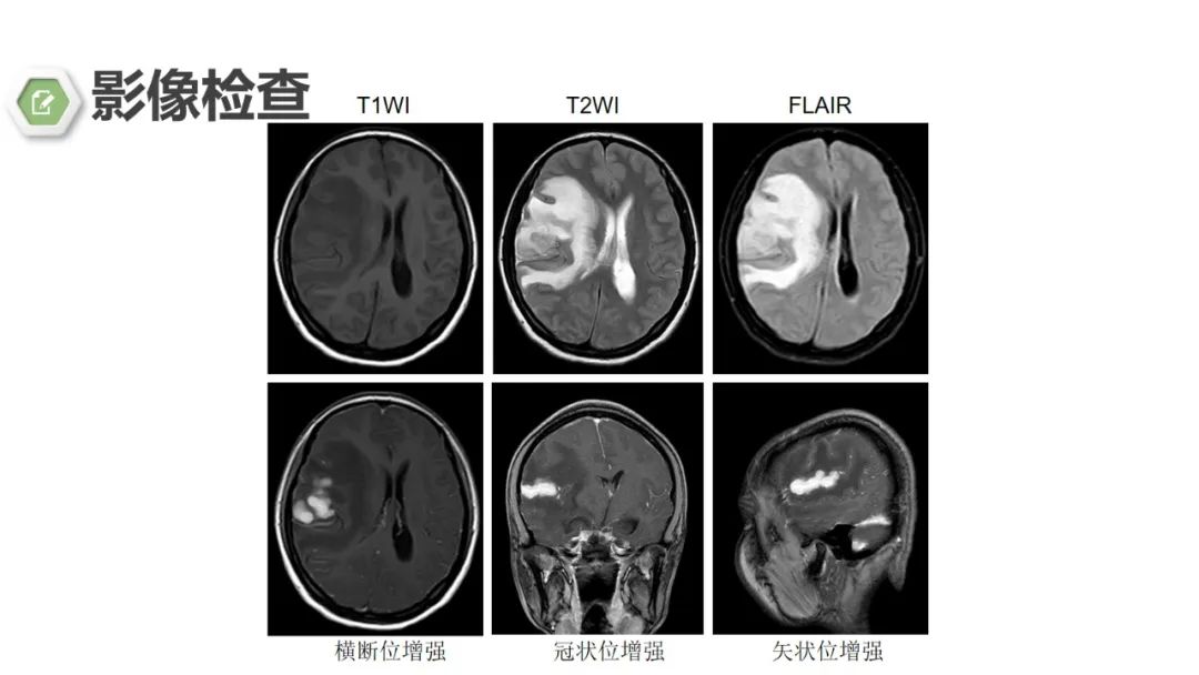 影像PPT - 【病例】颅内结核1例CT及MR影像-11 影像PPT - 【病例】颅内结核1例CT及MR影像-11
