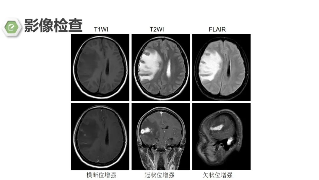 影像PPT - 【病例】颅内结核1例CT及MR影像-12 影像PPT - 【病例】颅内结核1例CT及MR影像-12