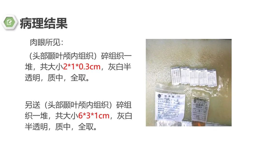 影像PPT - 【病例】颅内结核1例CT及MR影像-15 影像PPT - 【病例】颅内结核1例CT及MR影像-15