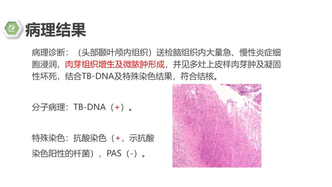 影像PPT - 【病例】颅内结核1例CT及MR影像-16 影像PPT - 【病例】颅内结核1例CT及MR影像-16