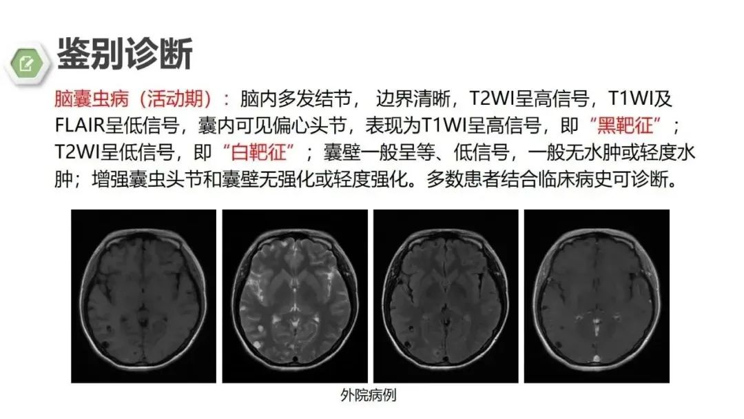 影像PPT - 【病例】颅内结核1例CT及MR影像-25 影像PPT - 【病例】颅内结核1例CT及MR影像-25