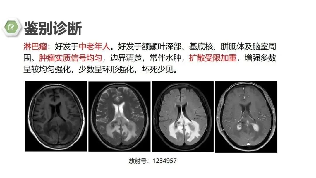 影像PPT - 【病例】颅内结核1例CT及MR影像-26 影像PPT - 【病例】颅内结核1例CT及MR影像-26