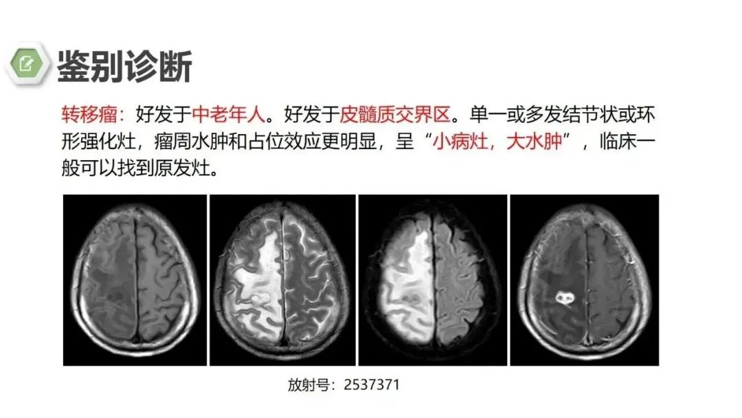 影像PPT - 【病例】颅内结核1例CT及MR影像-27 影像PPT - 【病例】颅内结核1例CT及MR影像-27
