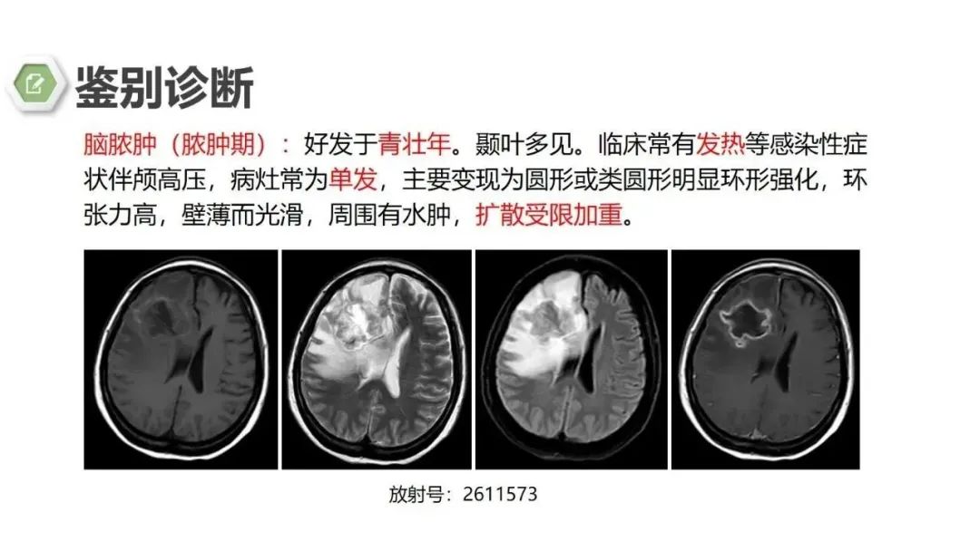 影像PPT - 【病例】颅内结核1例CT及MR影像-28 影像PPT - 【病例】颅内结核1例CT及MR影像-28
