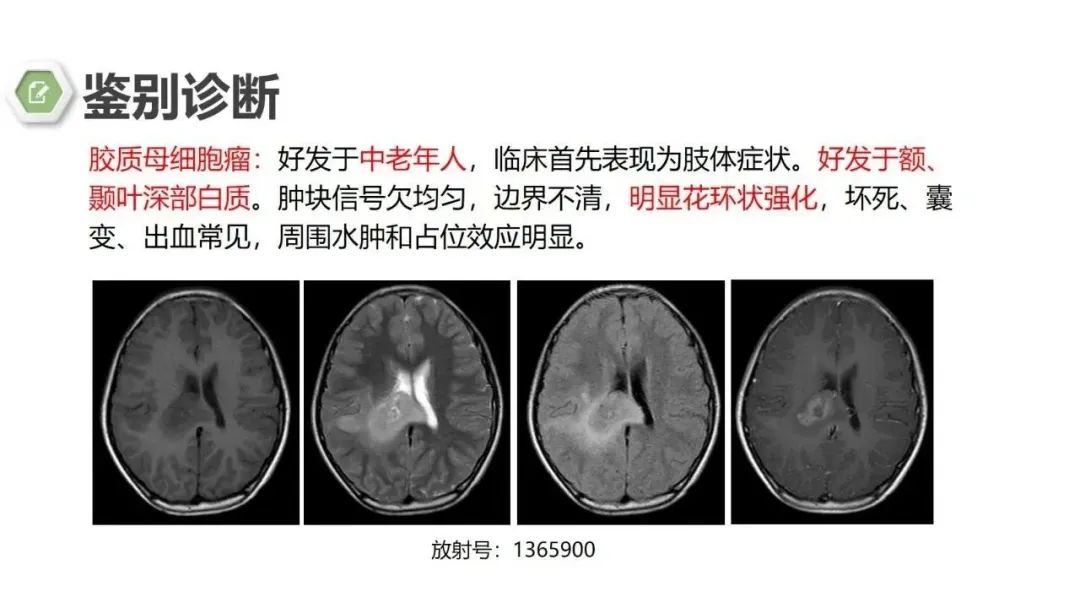 影像PPT - 【病例】颅内结核1例CT及MR影像-29 影像PPT - 【病例】颅内结核1例CT及MR影像-29