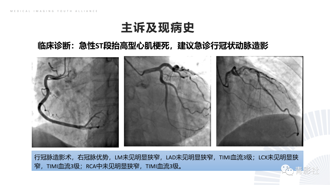 影像PPT - 【PPT】CMR在非冠状动脉阻塞性急性心肌损伤中的价值-8
