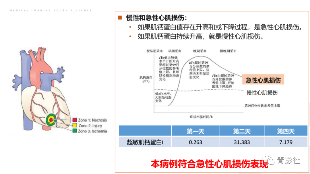 影像PPT - 【PPT】CMR在非冠状动脉阻塞性急性心肌损伤中的价值-9