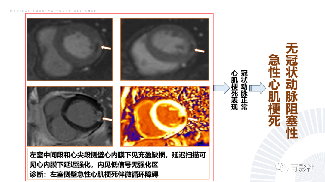 影像PPT - 【PPT】CMR在非冠状动脉阻塞性急性心肌损伤中的价值-13