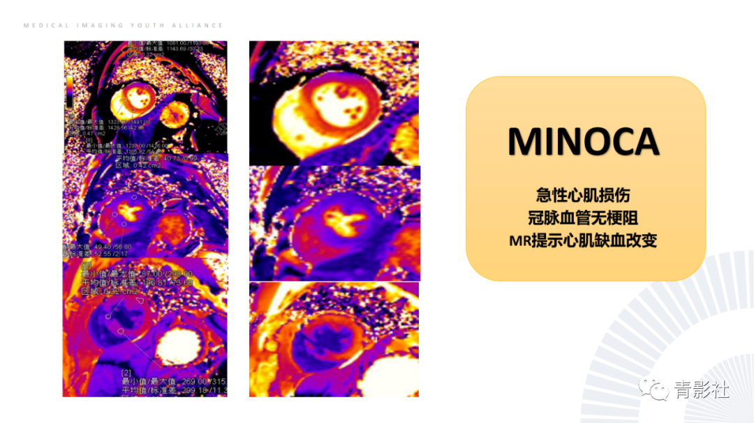 影像PPT - 【PPT】CMR在非冠状动脉阻塞性急性心肌损伤中的价值-20