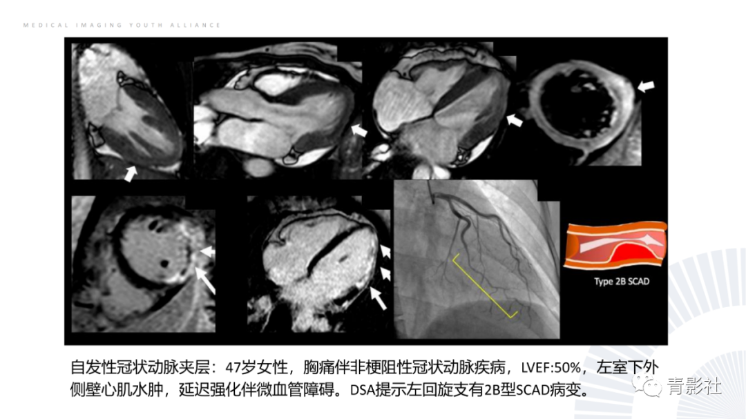 影像PPT - 【PPT】CMR在非冠状动脉阻塞性急性心肌损伤中的价值-22